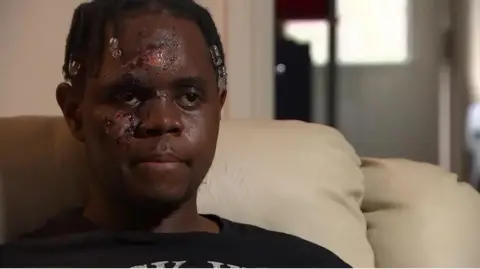 A picture of Katungua Tjitendero, taken shortly after the attack. He is sitting on a cream coloured sofa wearing a black t-shirt. His hair is in braids with clear beads at the end. His face is severely injured and scarred on his forehead, his right eyebrow and right cheek.